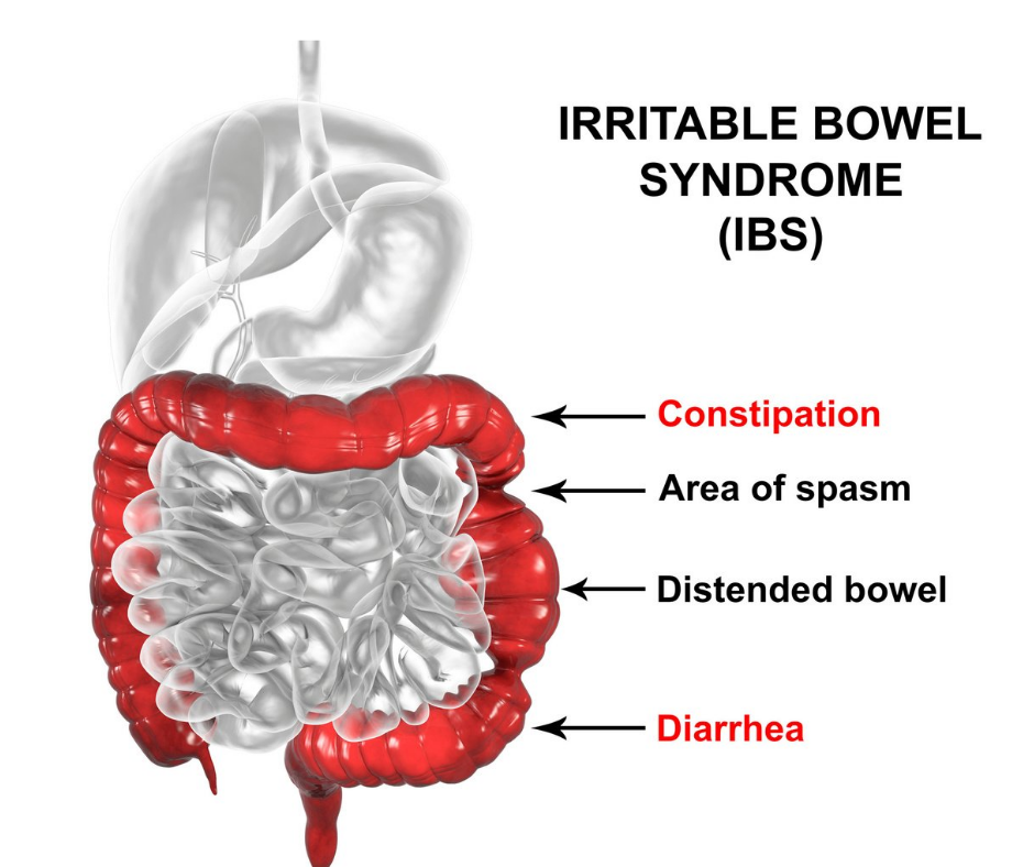 IBS hep at the Northampton Colonic Clinic